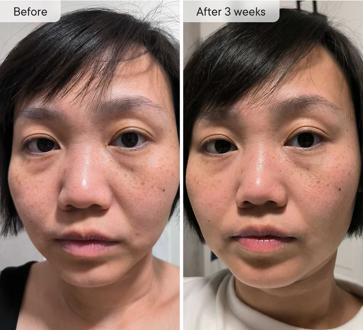 MOVI. Micro-Infusion Patches