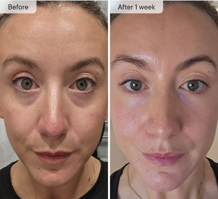 MOVI. Micro-Infusion Patches