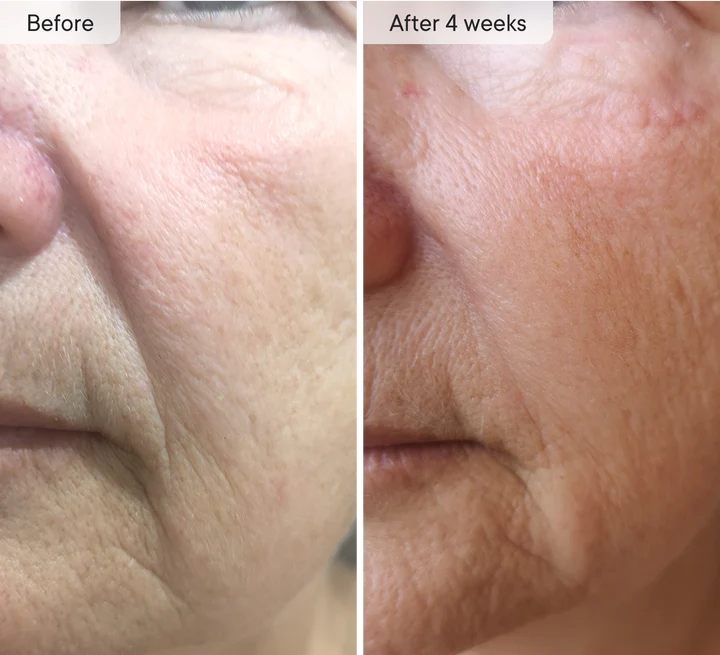 MOVI. Micro-Infusion Patches