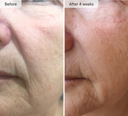 MOVI. Micro-Infusion Patches