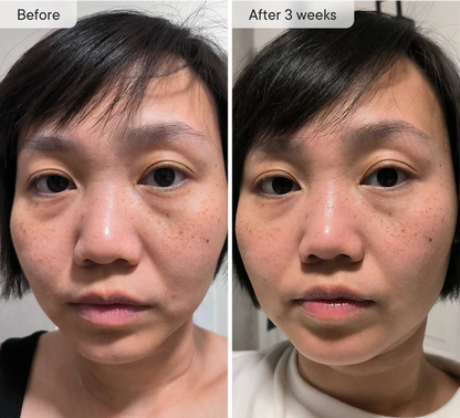 MOVI. Micro-Infusion Patches