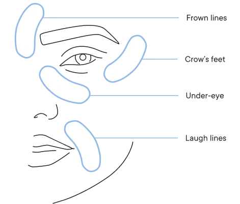MOVI. Micro-Infusion Patches
